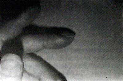 . Акропахия при болезни Грейвса: припухлость мягких тканей и увеличенная кривизна ногтевых пластинок