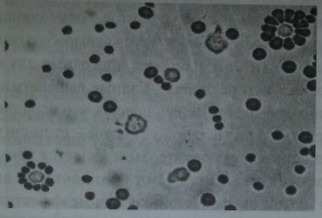 Два типа розеткообразующих кле¬ток человека. Вверху справа — лимфоцит, образовав-ший розетку с эритроцитами, сенсибилизи¬рованными неполными резус-антителами (В-лимфоцит), внизу слева - лимфоцит, об¬разовавший розетку с эритроцитами барана (Т-лимфоцит).