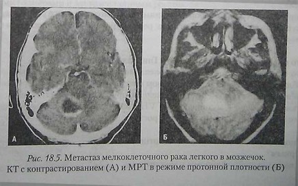 Метастаз мелкоклеточного рака легкого в мозжечок. КТ с контрастированием (А) и МРТ в режиме протонной плотности (Б)