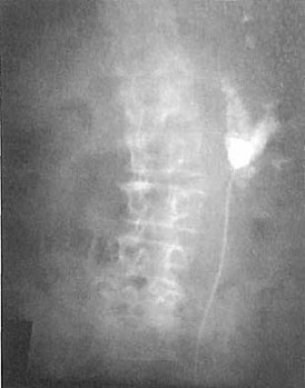 Ретроградная уретеро-пиелограмма слева. Травма почки тяжелой степени с разрывом па¬ренхимы и почечной лоханки. За¬текание рентгеноконтрастного ве¬щества в виде бесформенных пятен за контуром почечной лоханки.